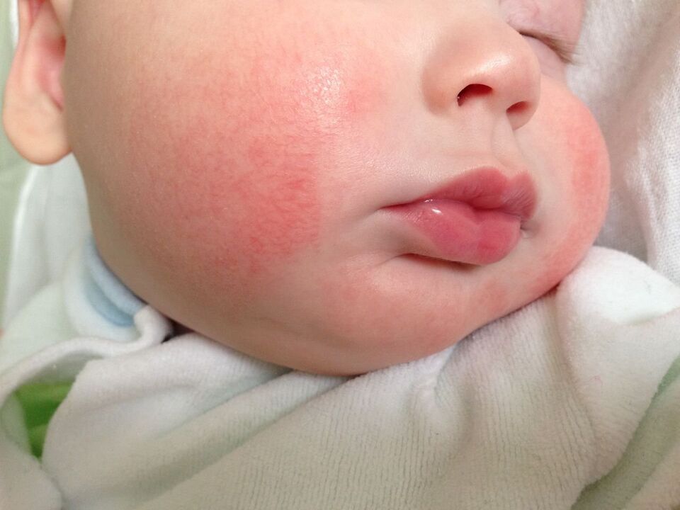 Znak črvov pri otroku je alergijska urtikarija